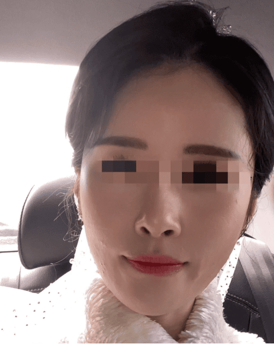 결혼식 여드름