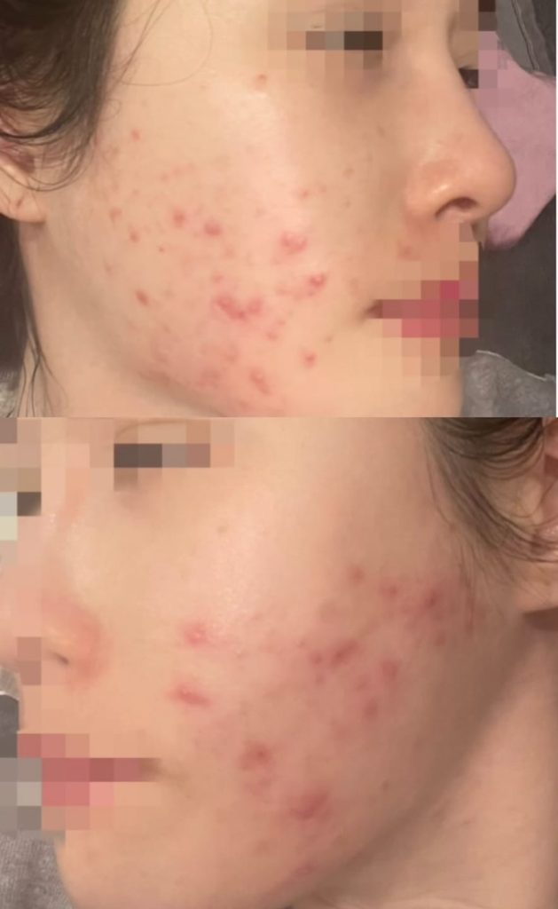 화농성 여드름