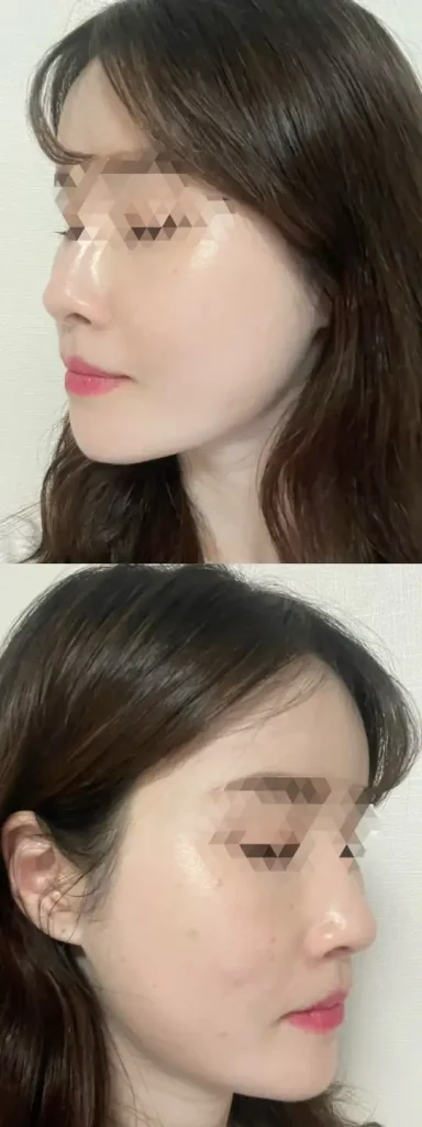 여드름 압출
