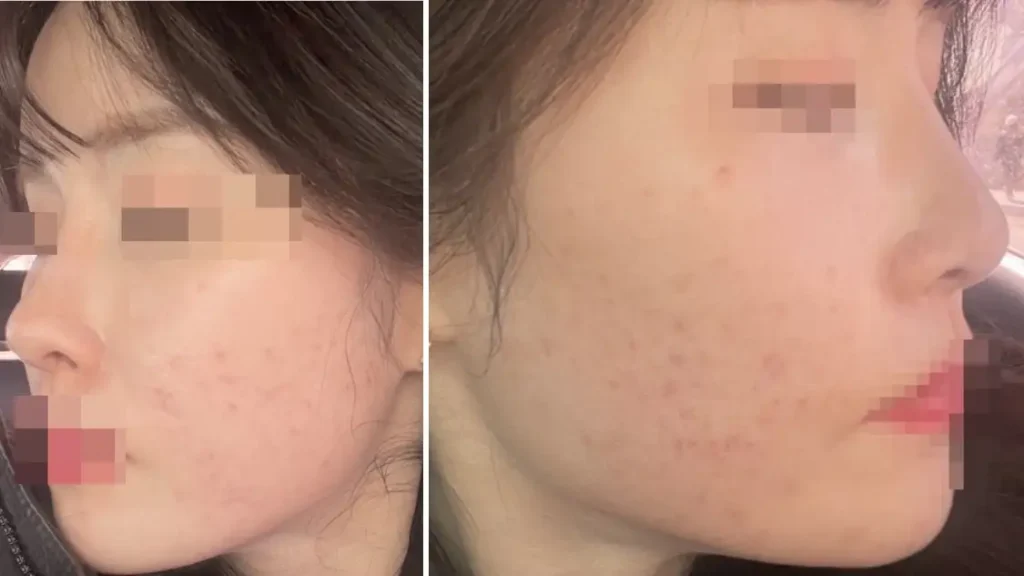 브이빔 레이저 효과