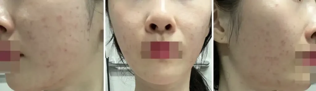 여드름 흉터 레이저