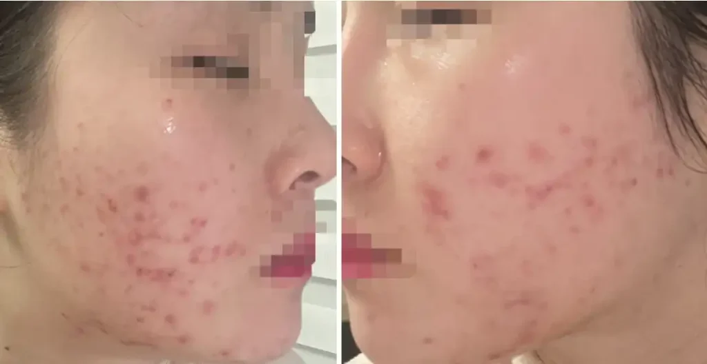 피부과 여드름 압출 비용