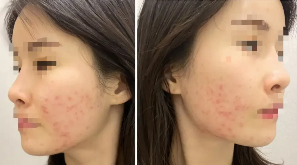 피부과 여드름 압출 비용