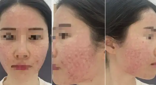 엑소좀 주사 후기