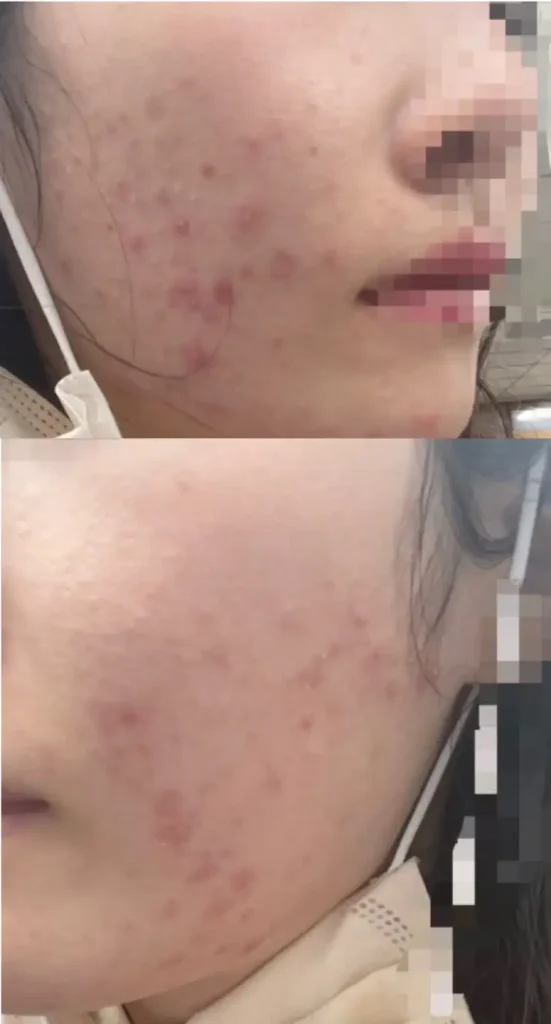 엑소좀 주사 맞기 전 여드름이 난 피부