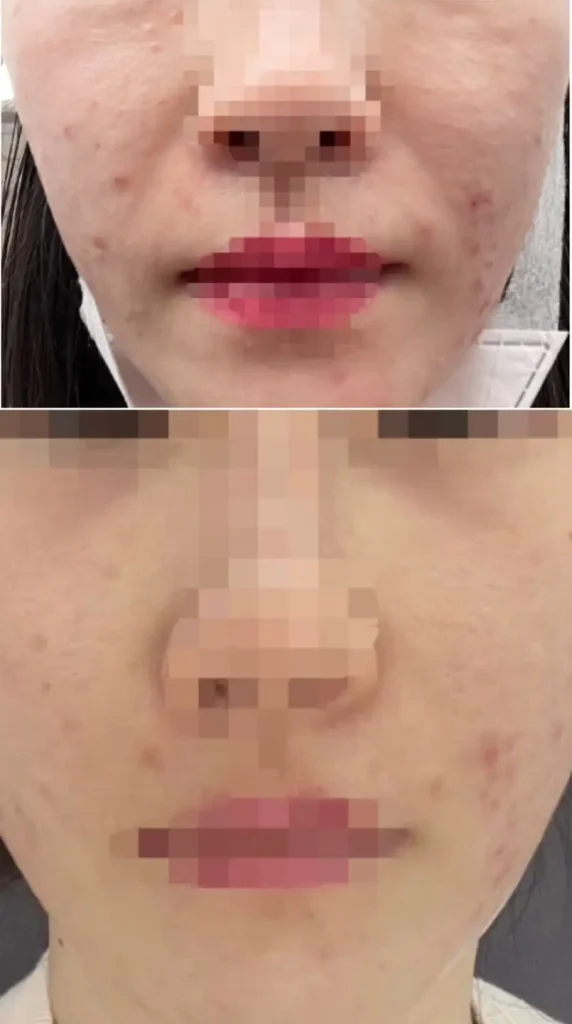 엑소좀 주사