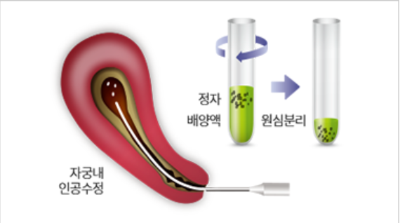인공수정 방법