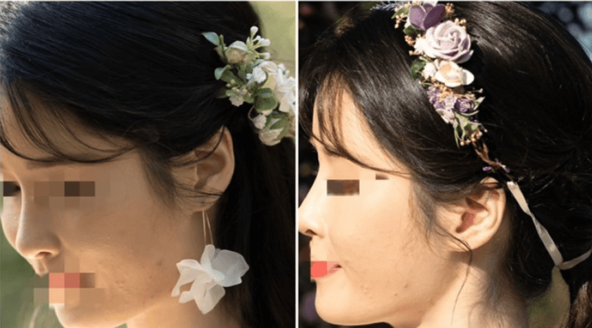 결혼식 피부 트러블