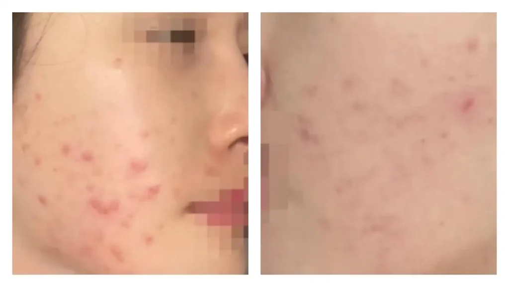 생리전 여드름
