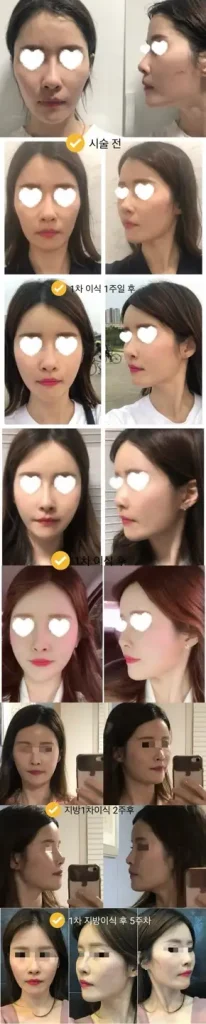 지방이식 1차 경과 모습