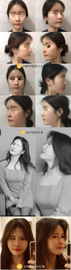 지방이식 2차 시술 후 사진