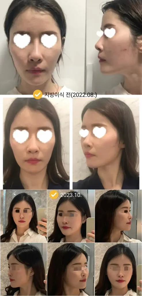지방이식 전후 사진