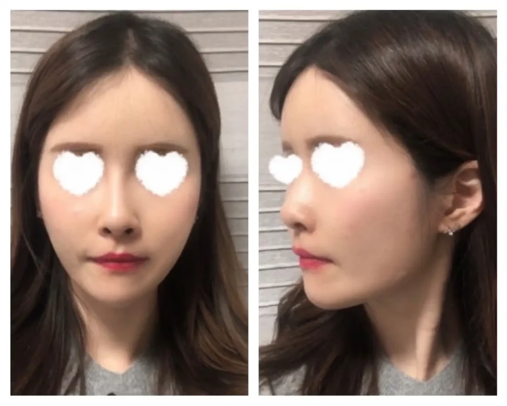 얼굴지방 이식 후