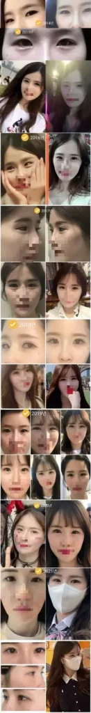 애교살 필러 시술 후기