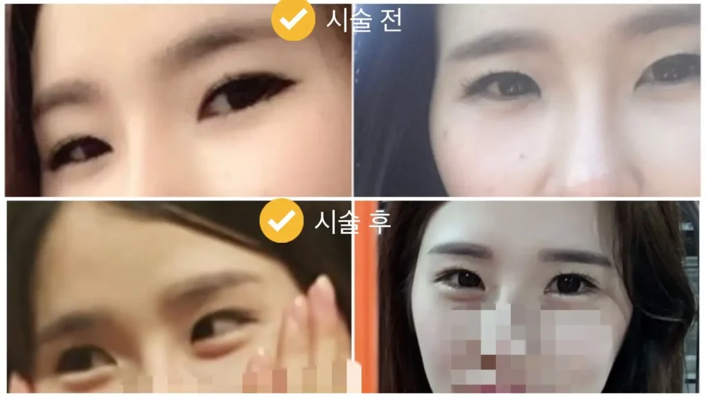 애교살 필러 시술전 시술후 눈 모양