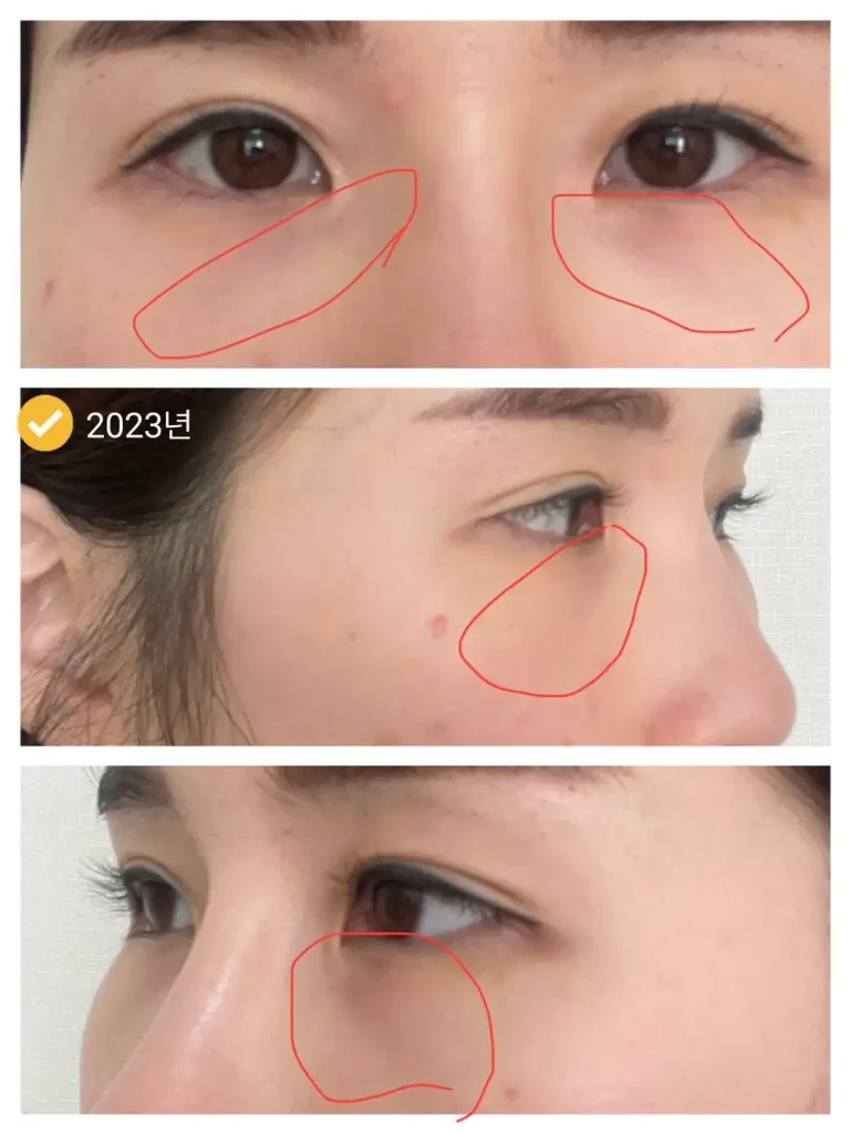 애교살필러시술 부작용 틴들현상 눈