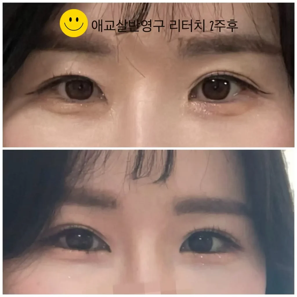 애교살 반영구 문신 전후 눈