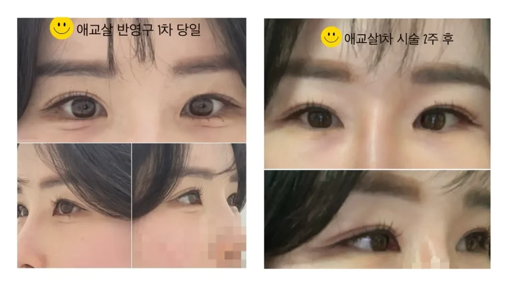 애교살 반영구 문신 1차 시술 후 눈