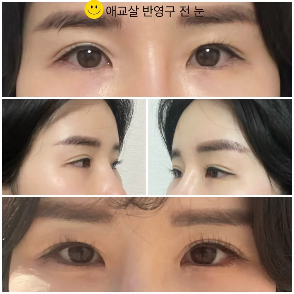애교살 반영구 문신 시술 전 눈