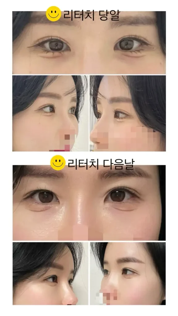애교살 반영구 문신 리터치 후 눈