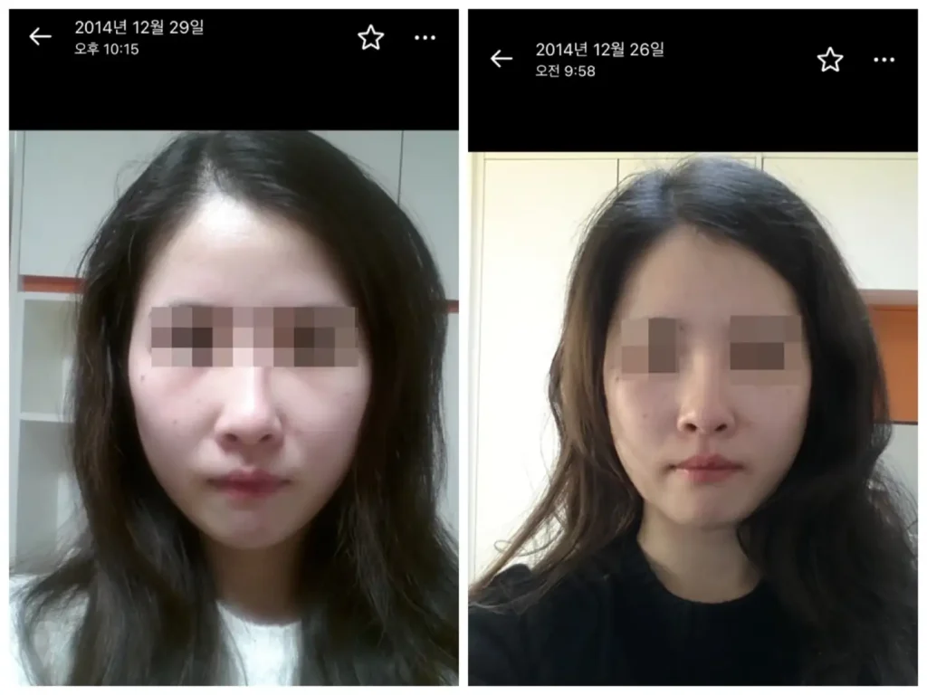 식이장애 얼굴형
